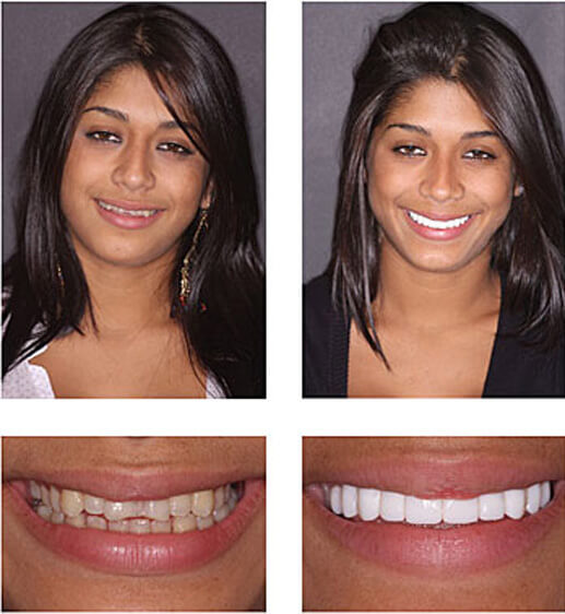 Brighten Your Smile Professional Teeth Whitening