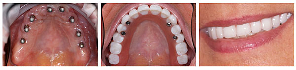 Fort Lauderdale Dentist implants