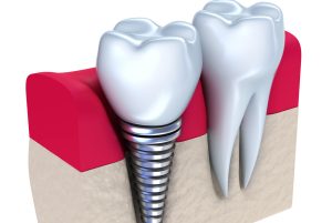 Dental Implant Treatment in Fort Lauderdale FL Area 
