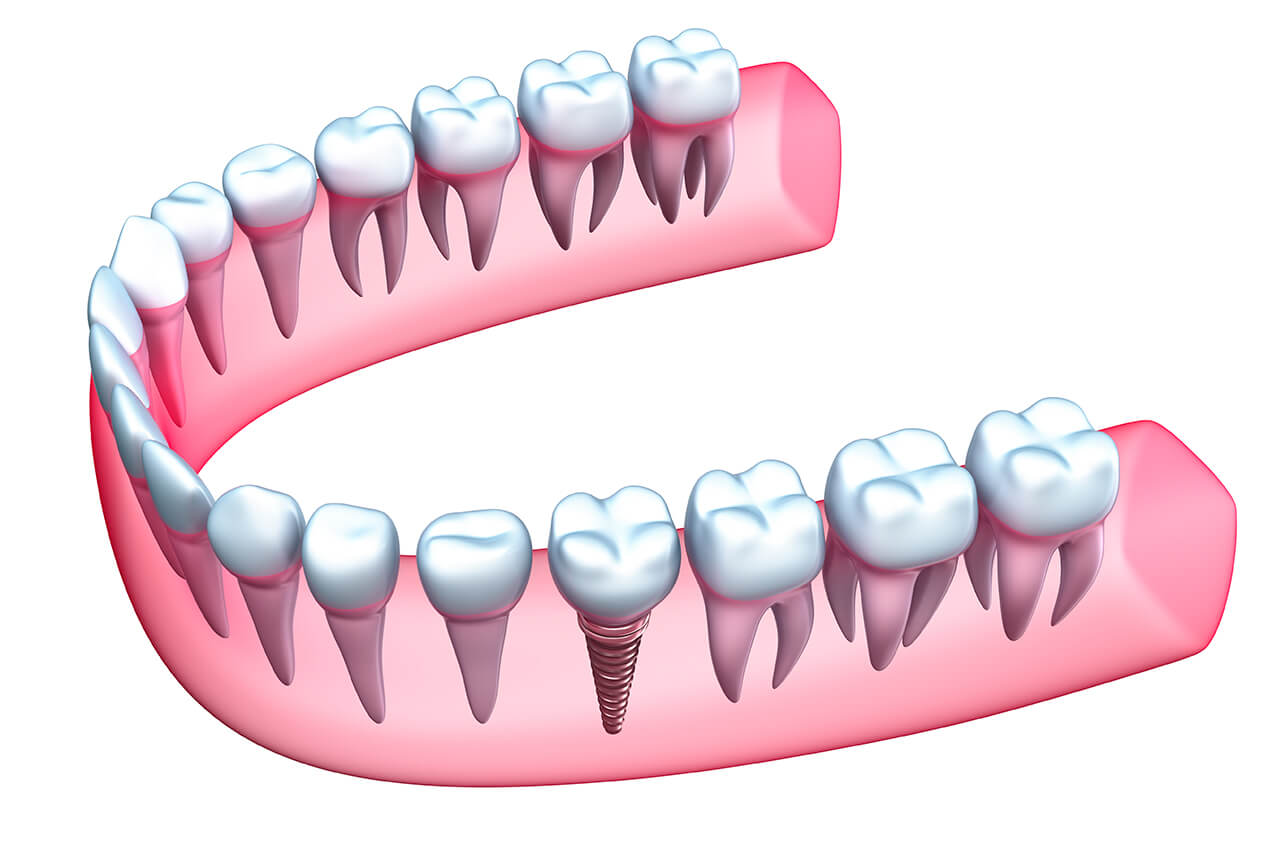 Dental Implant Cost in Fort Lauderdale Area