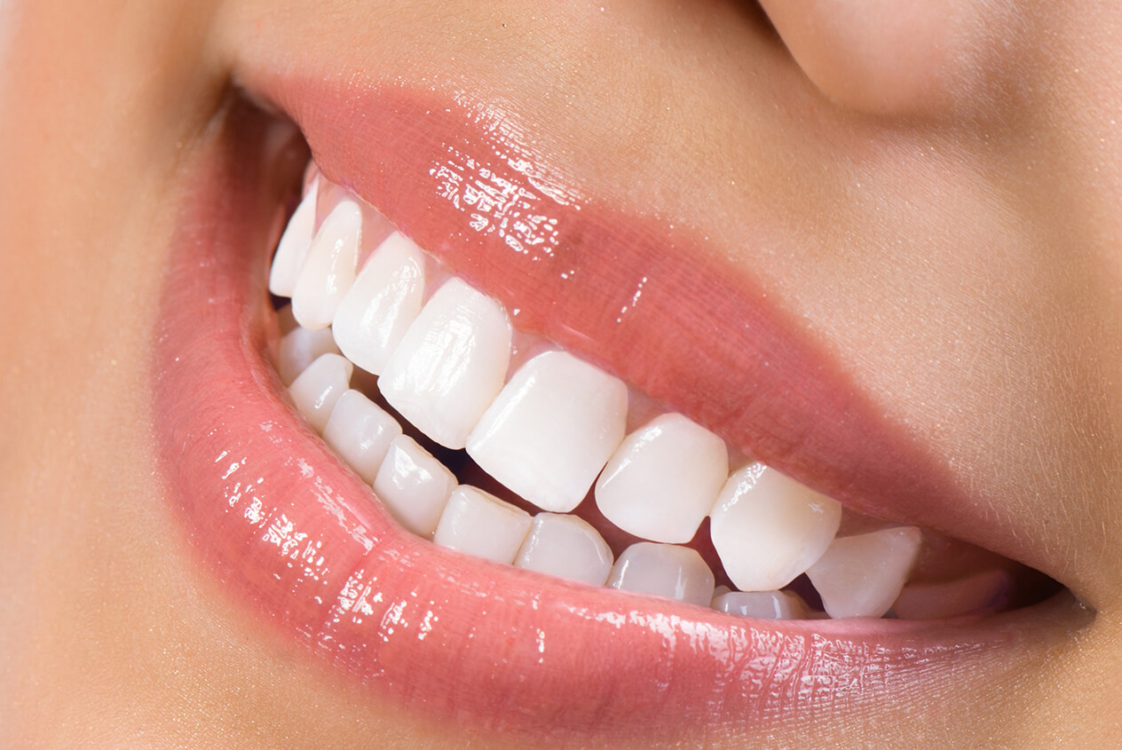 Professional Teeth Whitening Tips in Fort Lauderdale Area