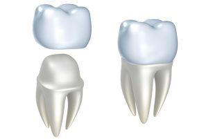 Dental Crown Replacement Fort Near Me In Lauderdale FL 