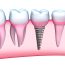 Restore your smile with dental implant services