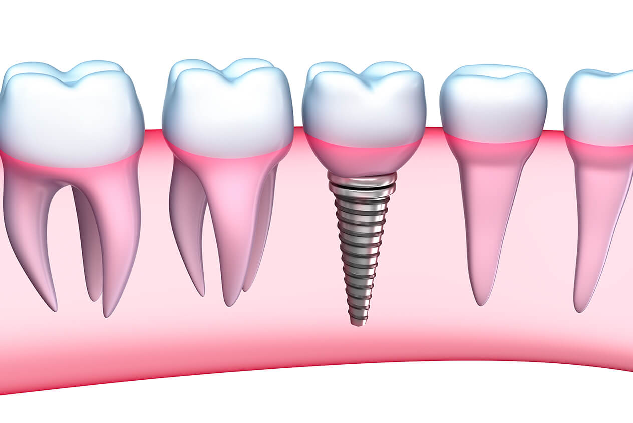 Dental Implant Services in Fort Lauderdale FL Area