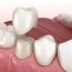 A guide to long-lasting dental crowns; when a crown may need to be replaced by our skilled cosmetic dentist