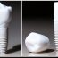 A Look Into Why Holistic Dentists Have Embraced Zirconia As A Choice For Dental Implants